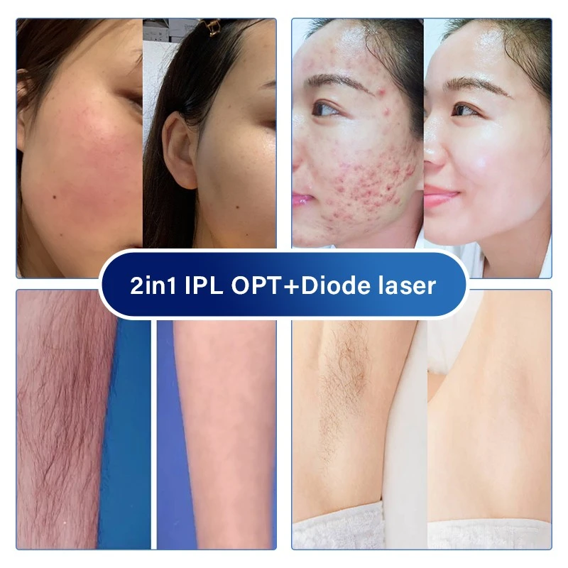 LPL Laser Hair Removal Machine
